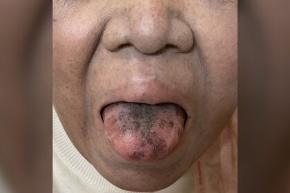 Black, hairy tongue developed after cancer