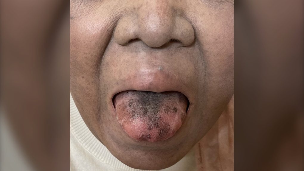 Black, hairy tongue developed after cancer