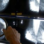 Should breast cancer screening begin at age 40?
