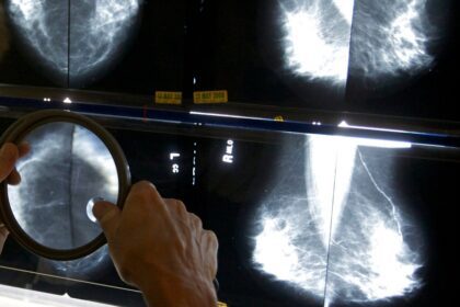 Should breast cancer screening begin at age 40?