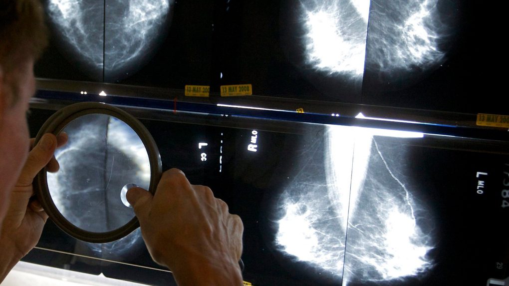 Should breast cancer screening begin at age 40?